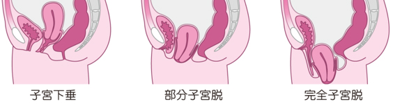 子宮脱説明図